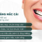 Niềng răng mắc cài