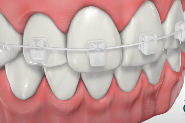 Ưu điểm của niềng răng mắc cài sứ