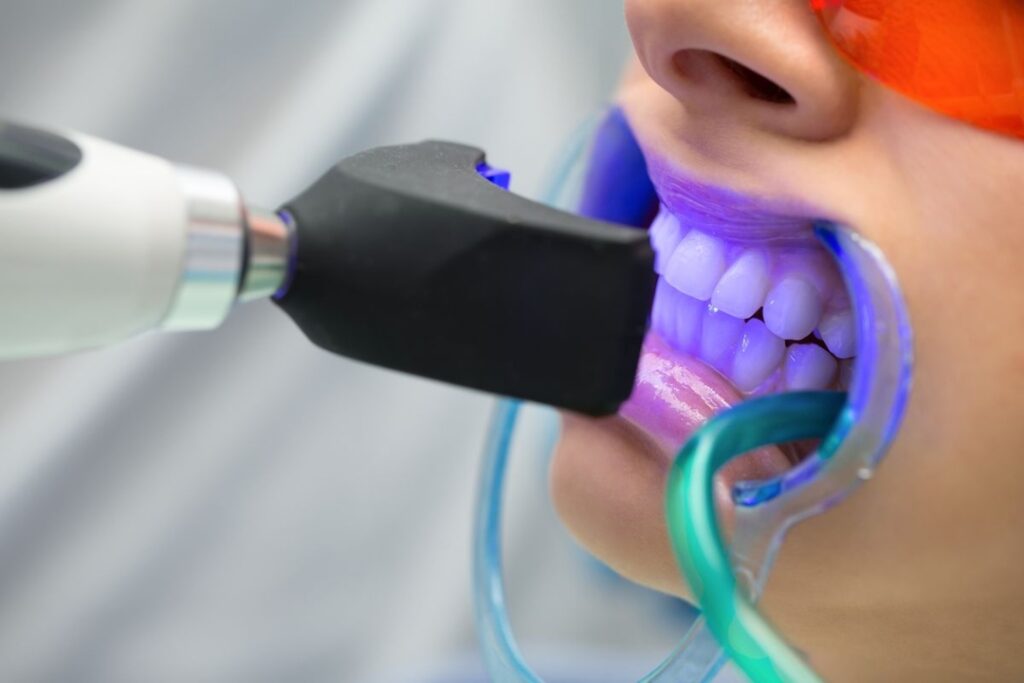 Tẩy trăng răng tại nha khoa sử dụng ánh sáng tím