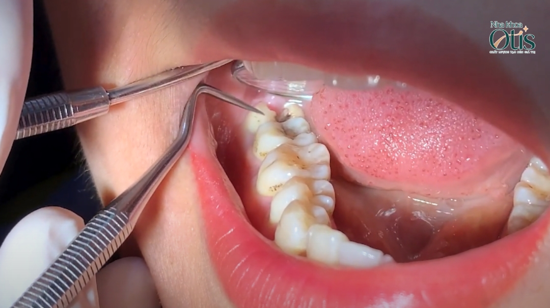 Răng khôn bị sâu do không đủ không gian mọc