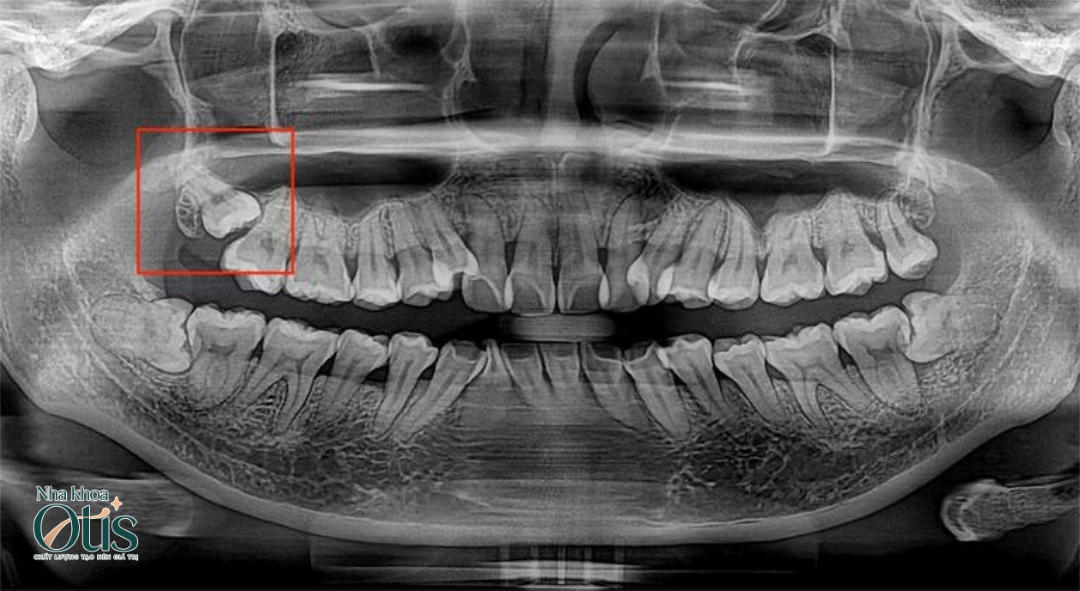 Răng khôn mọc lệch 45 độ chèn vào răng số 7