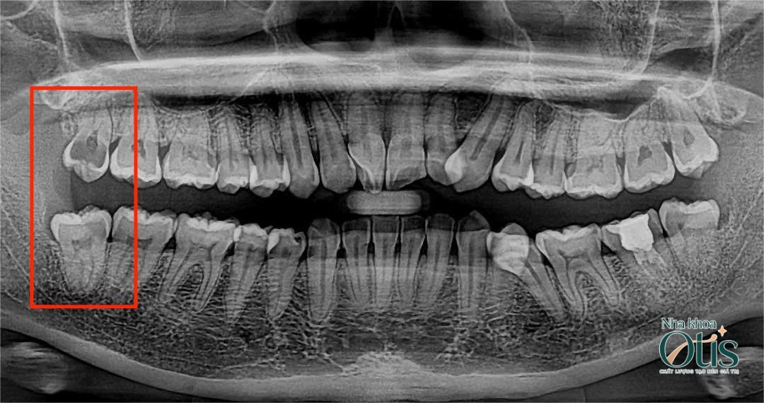 Không cần nhổ răng khôn mọc thẳng 