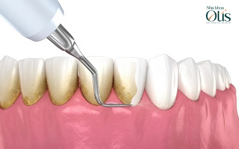 Lấy cao răng có đau không, câu trả lời là không
