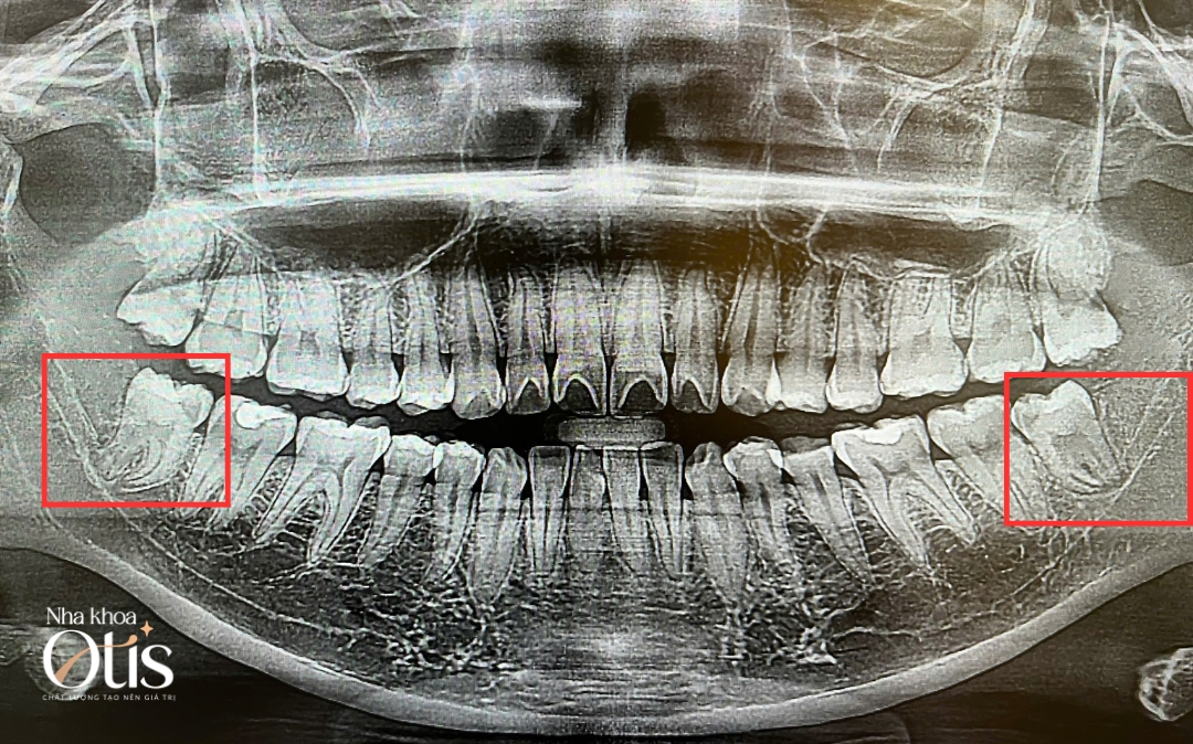 Răng khôn mọc lệch gần ống thần kinh
