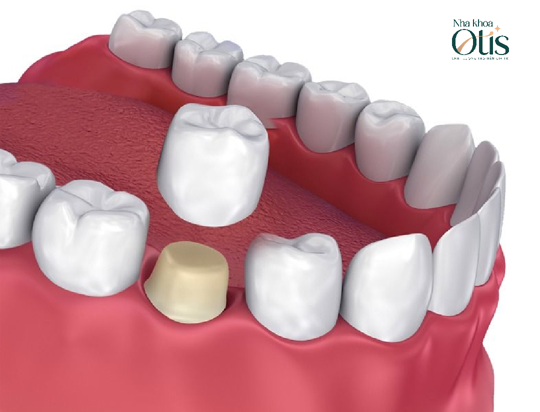 Mão sứ lắp không khớp gây cảm giác khó chịu