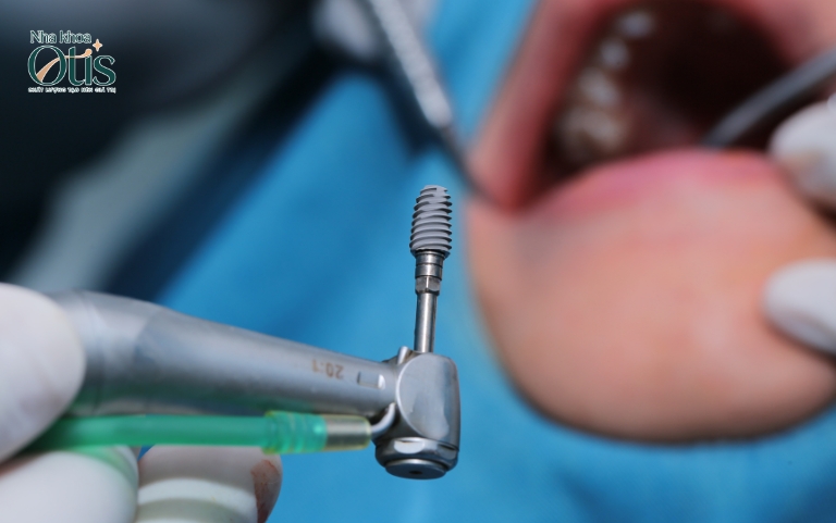 Trồng răng implant bao lâu phụ thuộc vào độ tích hợp nhờ chất lượng trụ