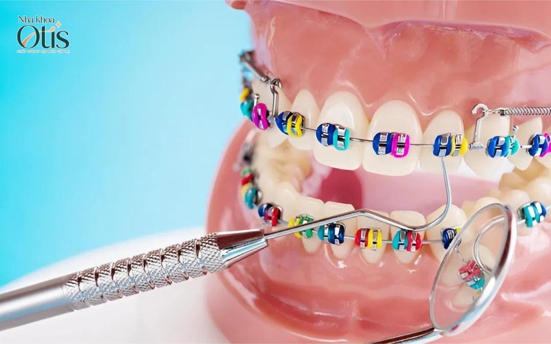 Niềng răng mắc cài dây chun