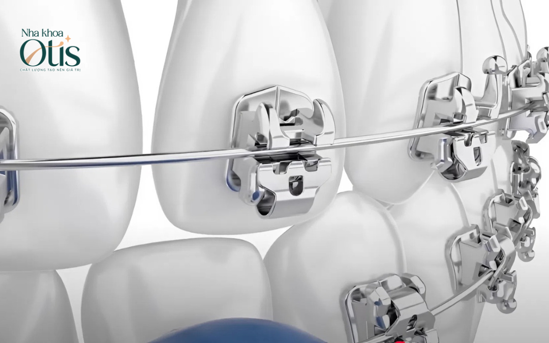 Niềng răng mắc cài kim loại có mấy loại