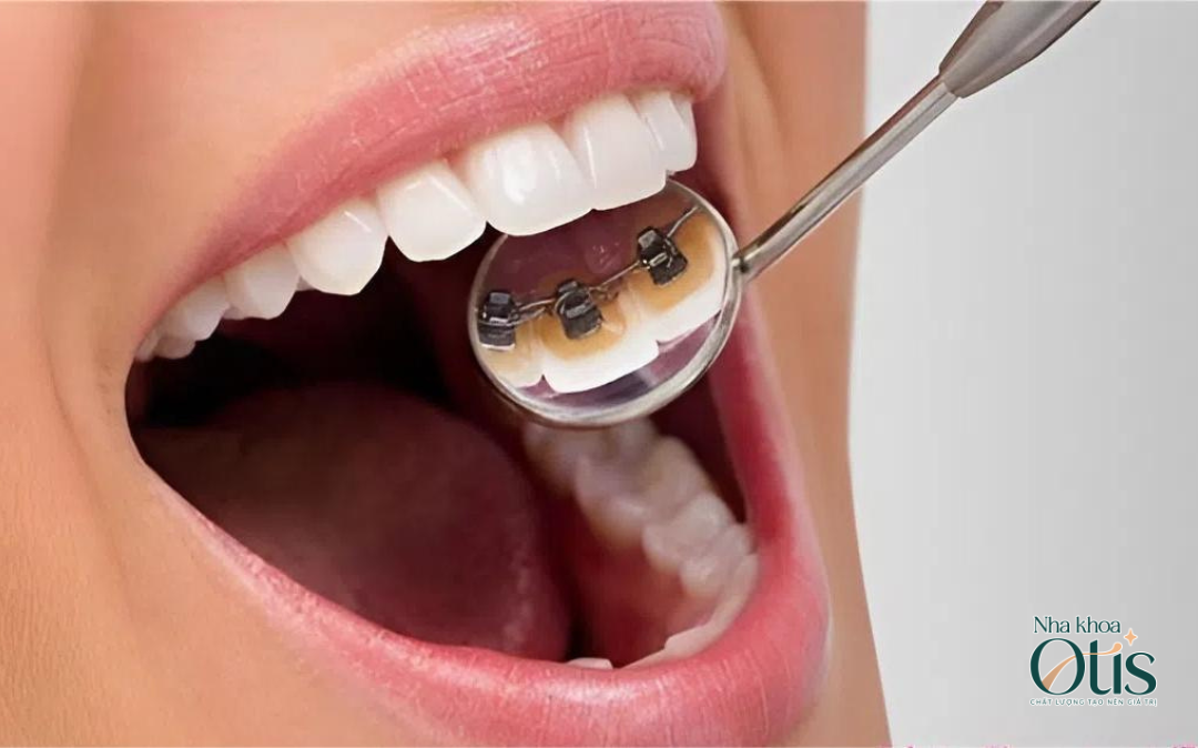 Niềng răng mắc cài mặt lưỡi có tính thẩm mỹ cao