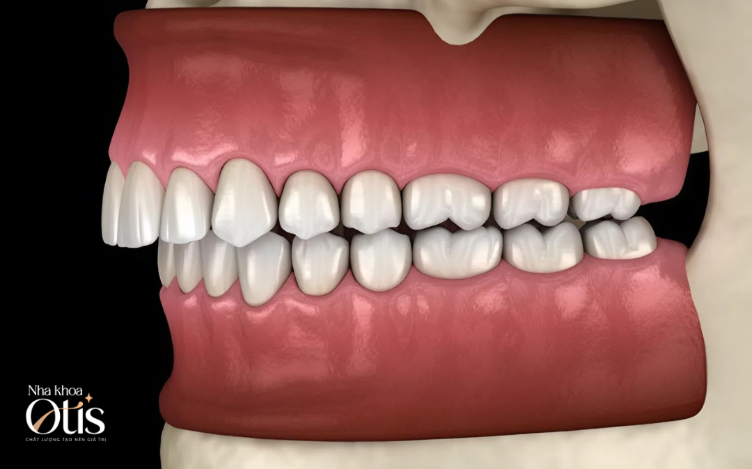 Răng sai khớp cắn thường sẽ được chỉ định nhổ khi niềng răng trong suốt