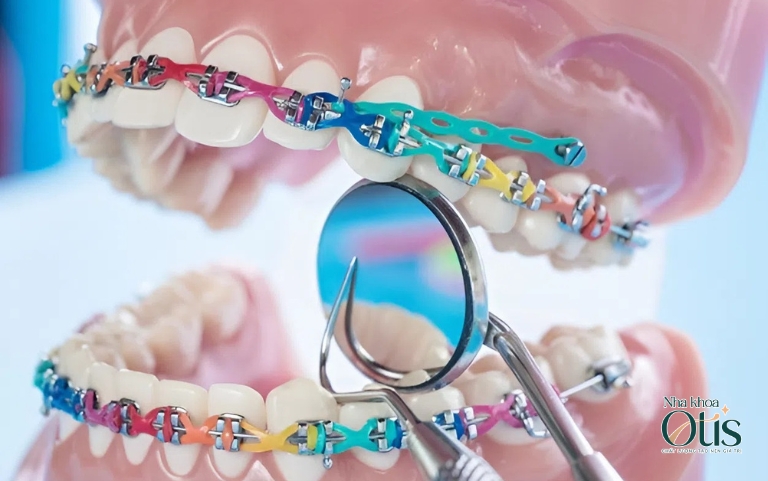 Niềng răng mắc cài kim loại buộc chun cố định dây cung kéo răng