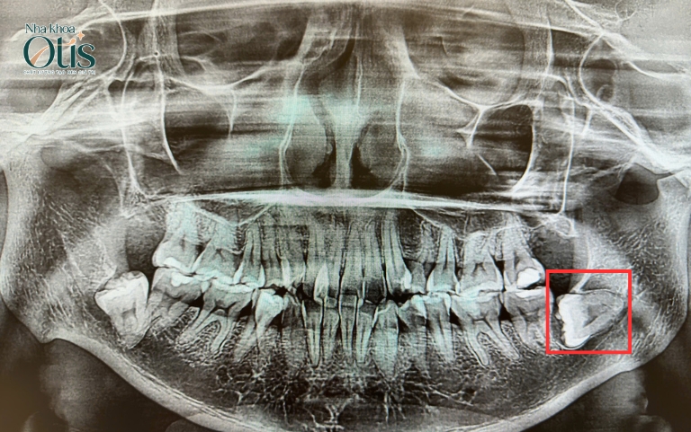 Chân răng phức tạp gây đau nhiều hơn
