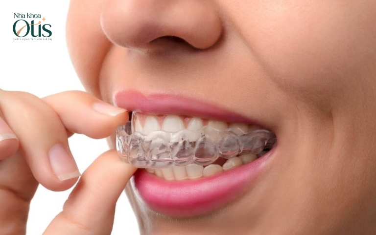 Niềng răng trong suốt mất bao lâu phụ thuộc vào tình trạng lệch của răng