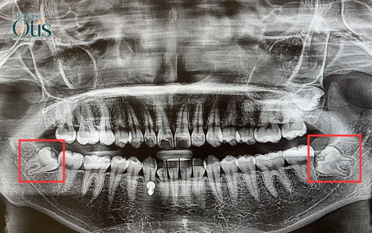 Có nên nhổ răng khôn khi răng mọc lệch