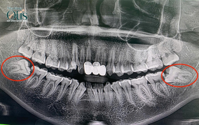 Nhổ răng khôn hàm dưới có nguy hiểm không 