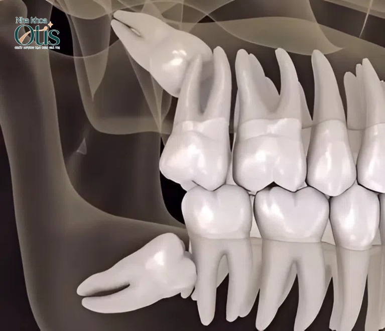 Nhổ răng khôn hàm trên không đau