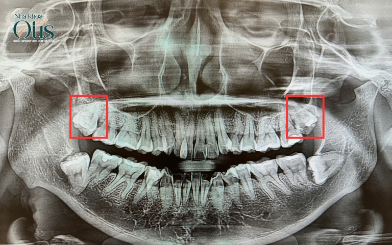 Nhổ răng khôn hàm trên khi răng mọc lệch
