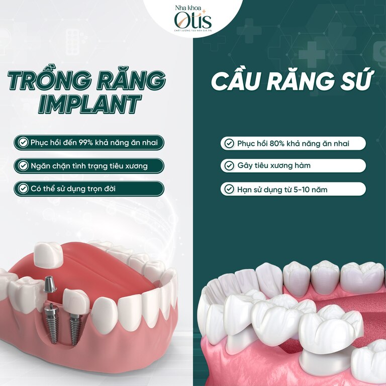 Trồng răng Implant bền hơn cầu răng sứ