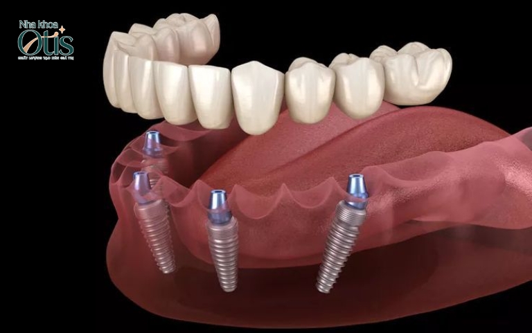 Trồng răng Implant all on 4 với 4 trụ