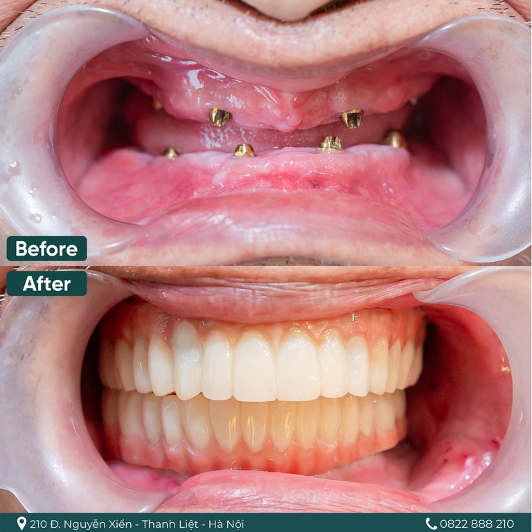 Trồng răng Implant all on 4 chắc chắn