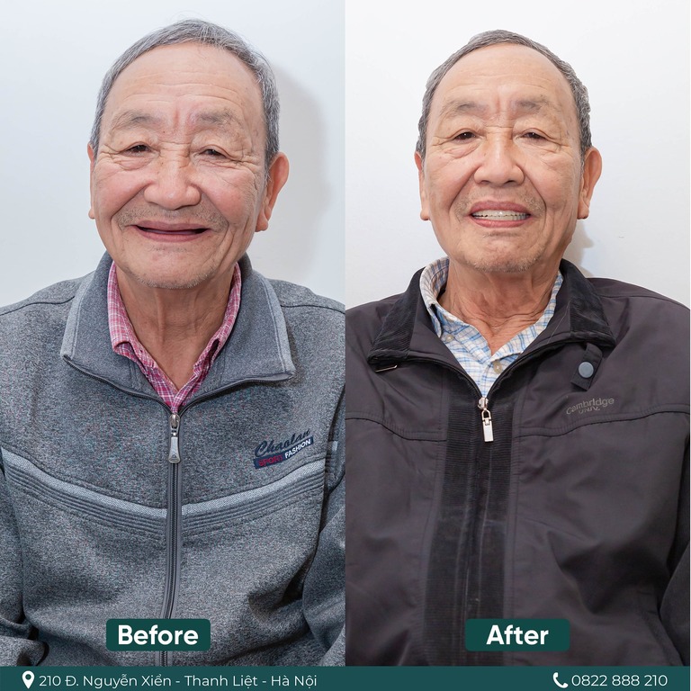 Trồng răng Implant hàm all on 4 phù hợp với người mất nhiều răng