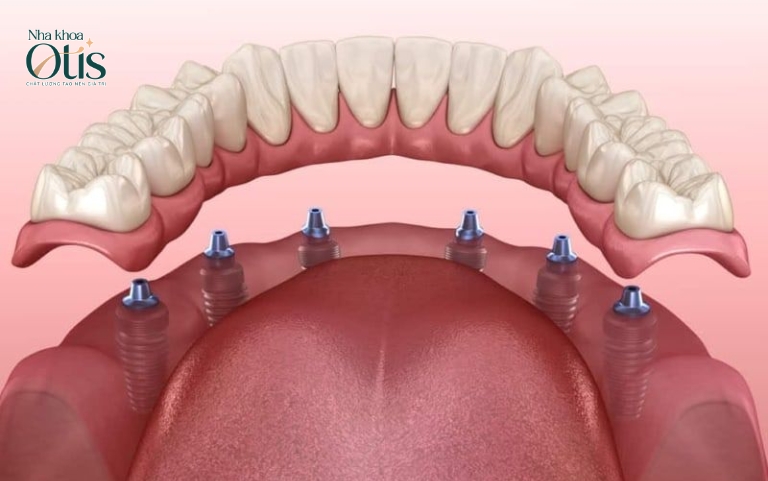 Trồng răng Implant all on 6 sử dụng 6 trụ nâng đỡ răng sứ