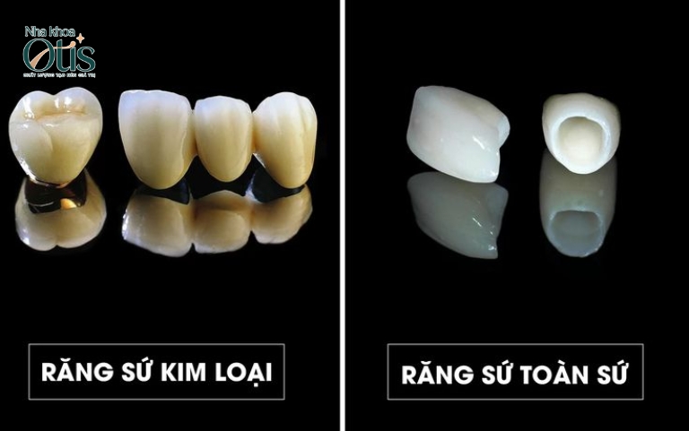 Bọc răng sứ giữ được bao lâu tùy vào loại răng sứ