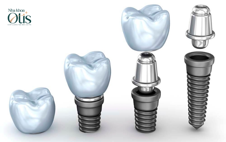 Cấu tạo răng implant gồm 3 phần
