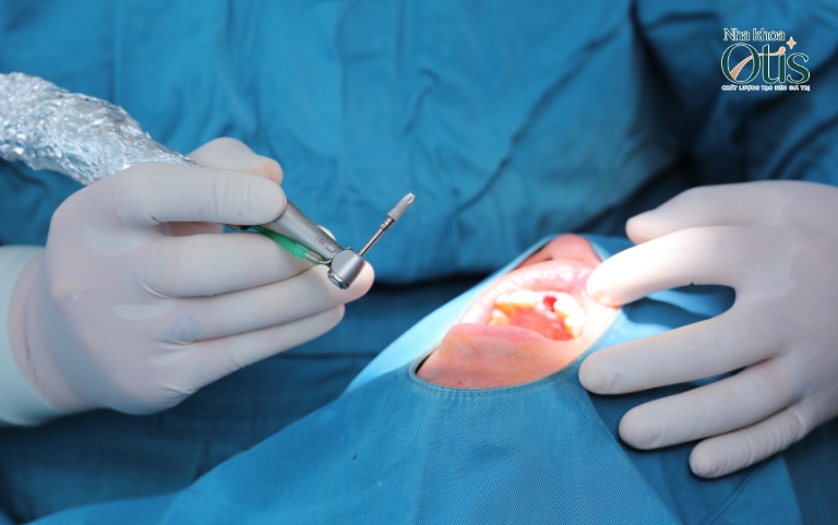 Cấu tạo răng Implant với trụ implant quan trọng
