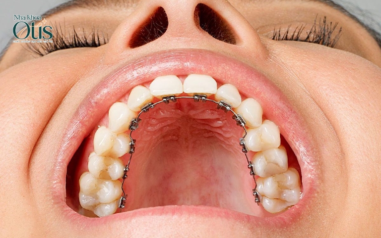 Niềng răng mắc cài mặt trong phù hợp với nhiều tình trạng răng