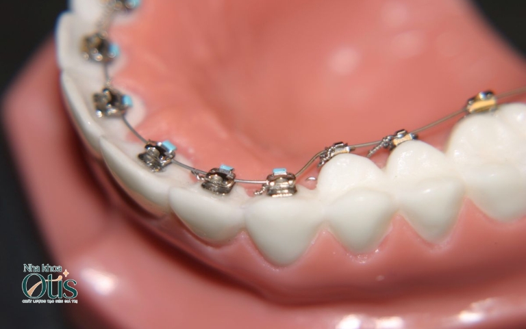 Niềng răng mắc cài mặt trong được lắp giấu ở bên trong răng