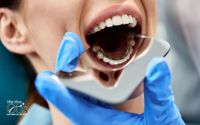 Niềng răng mắc cài mặt trong khó nhìn thấy