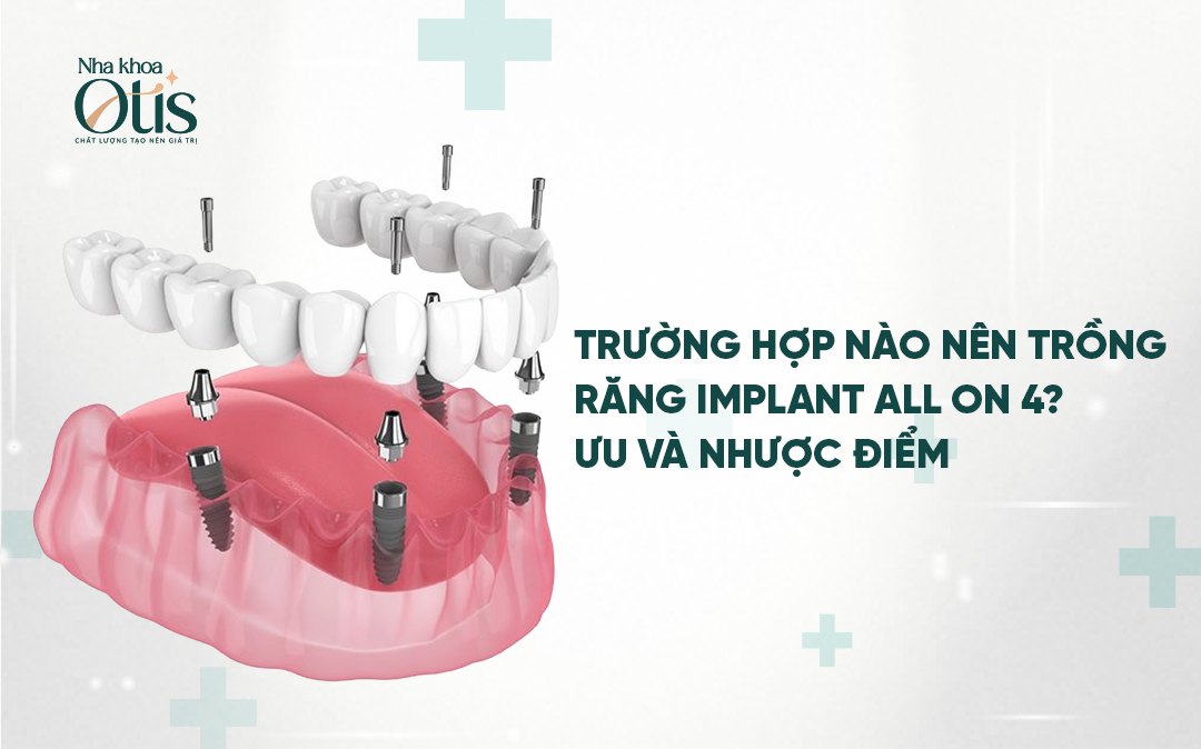 Trồng răng Implant all on 4 cho toàn hàm
