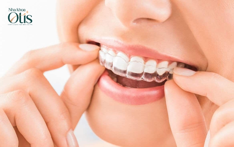 Niềng răng trong suốt và niềng răng mắc cài nên lựa chọn loại nào