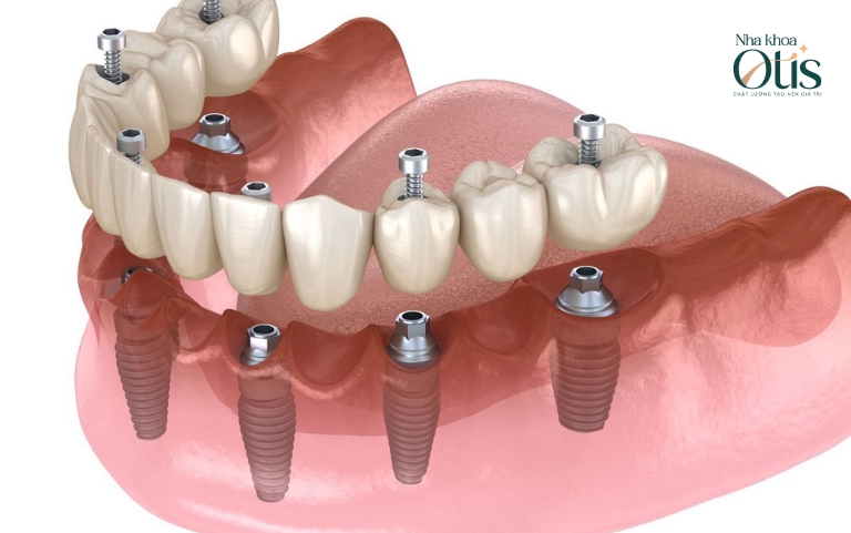 Trồng răng implant toàn hàm sử dụng 4-6 trụ trên hàm