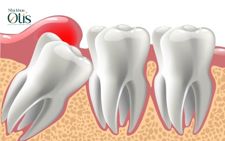 Vì sao phải nhổ răng khôn do răng khôn mọc lệch