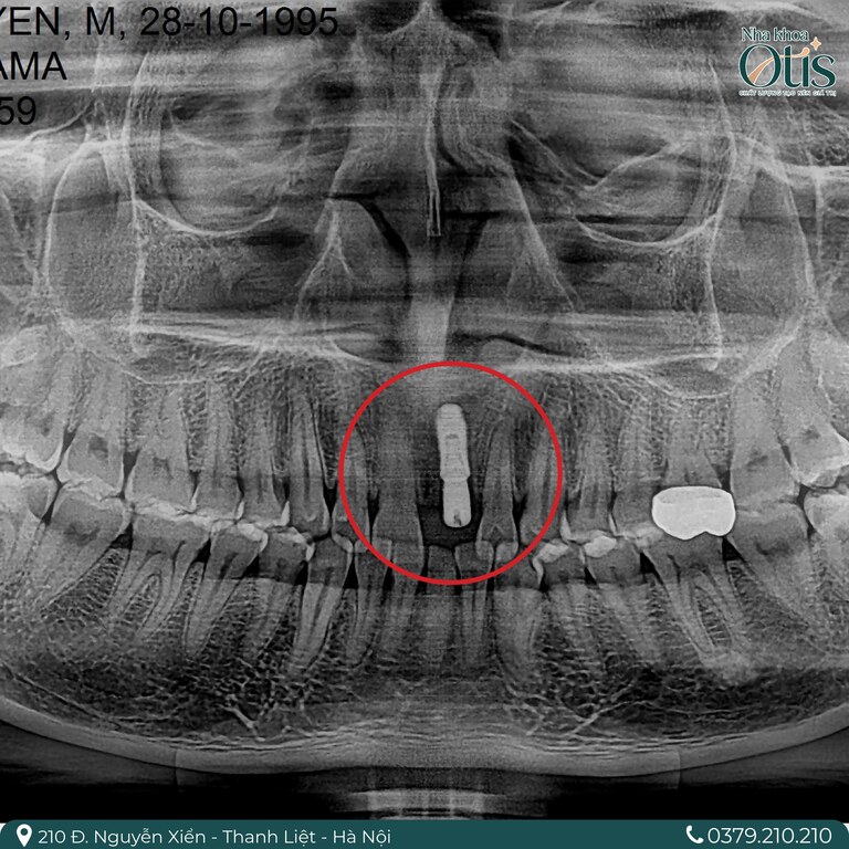 Trồng răng Implant 1 răng