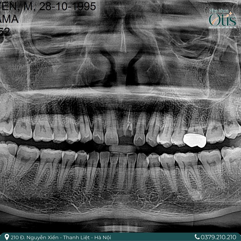 Trồng răng Implant khi chân răng gốc yếu