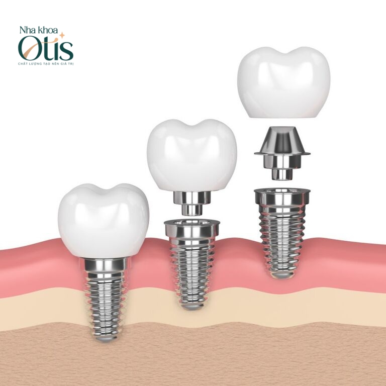 Trồng răng Implant có tốt không tùy thuộc vào cấu tạo trụ Implant