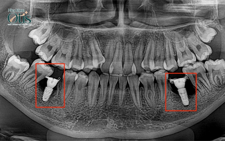 Điều kiện trồng răng Implant khi xương hàm chắc