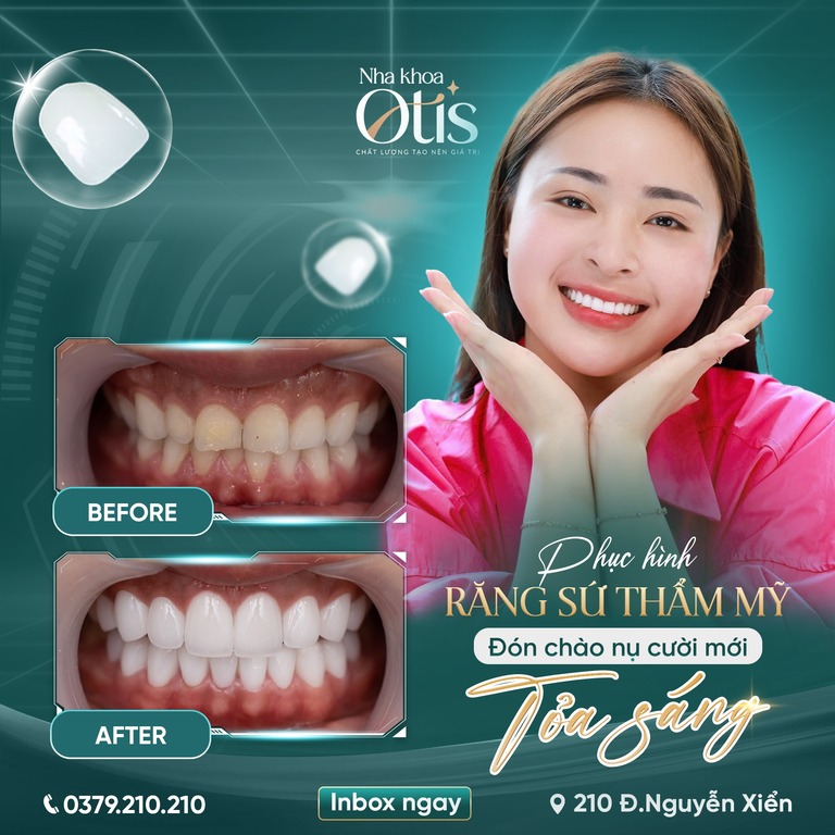 Bọc răng sứ tại Nha khoa OTIS