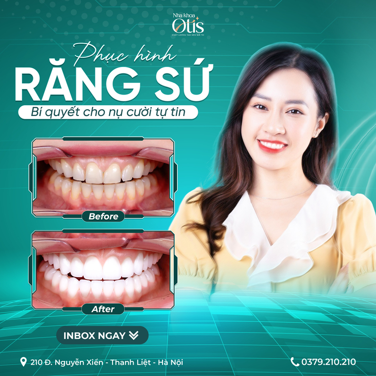 Bọc răng sứ có tốt không với các ưu điểm trắng sáng vượt trội
