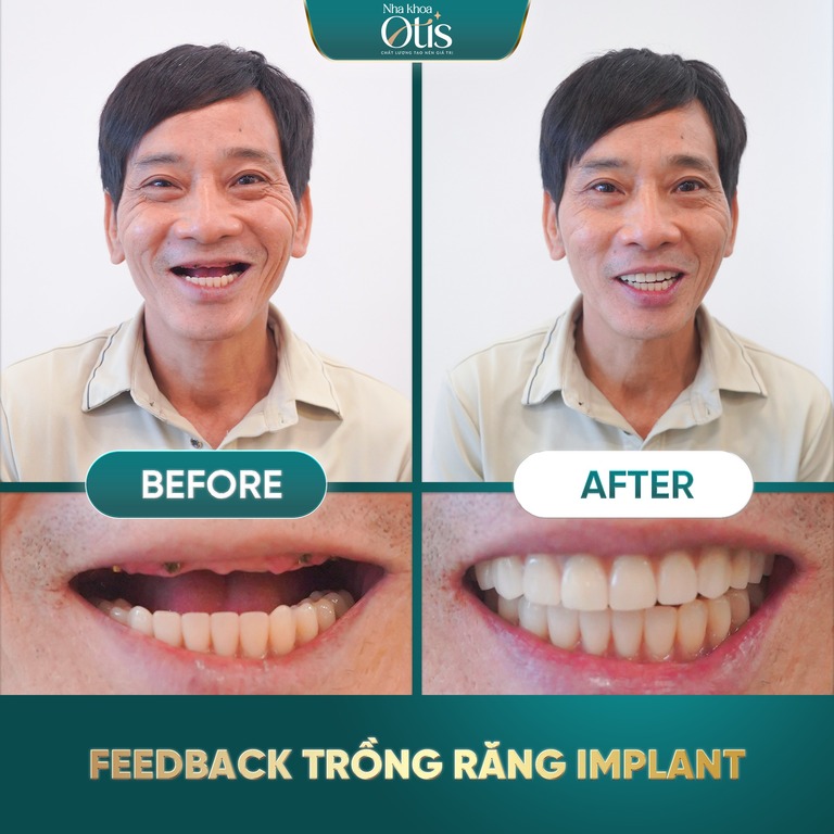 Người già mất răng toàn hàm nên trồng răng Implant