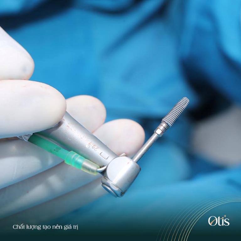 Trụ Implant có cấu tạo xoắn ốc