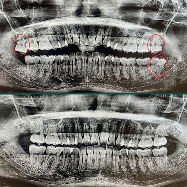Sau nhổ răng khôn các răng bình thường