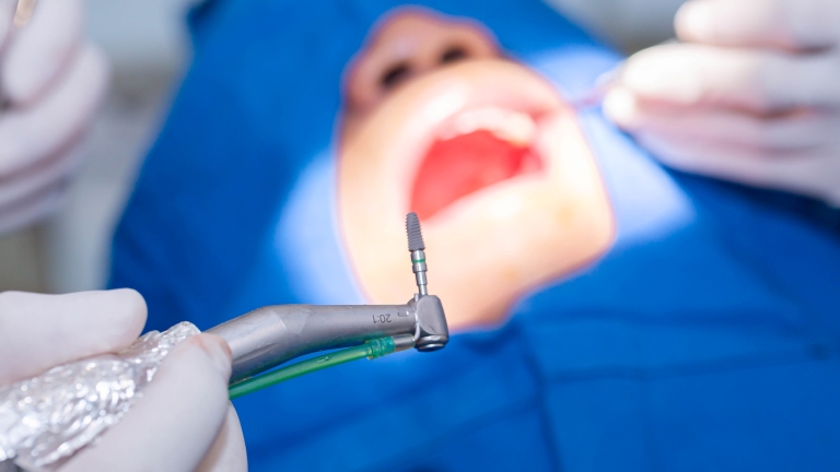 Quá trình trồng răng implant