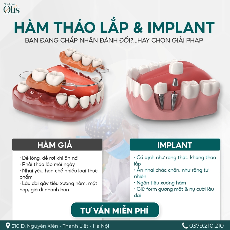 Mất nhiều răng nên lựa chọn trồng răng implant