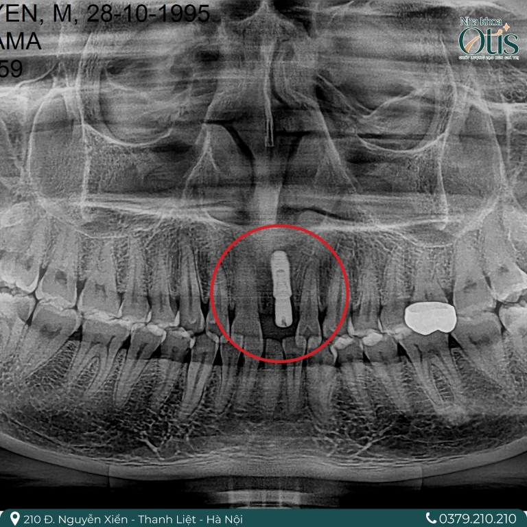 Kỹ thuật trồng răng implant đơn lẻ