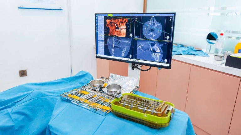 Xương hàm mỏng cần ghép xương cấy implant