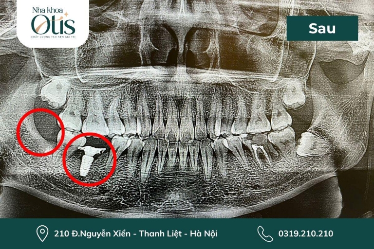 Sau khi nhổ răng bao lâu thì trồng implant